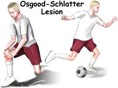 Anatomy What part of the knee is affected? Introduction An Osgood-Schlatter lesion involves pain and swelling in the small bump of bone on the front of the tibia (shinbone), right below the kneecap.