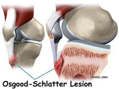 Causes How did this problem develop? Osgood-Schlatter lesions fit in a category of bone development disorders known as osteochondroses. (Osteo means bone, and chondro means cartilage.