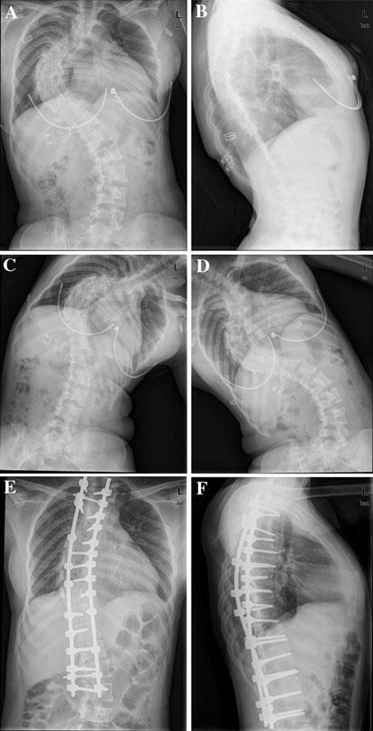 Eur Spine J (2011) 20:118 122 119 less than 70. Later as we gained greater experience with the technique, the temporary shape memory alloy rod was employed on scoliosis greater than 70.
