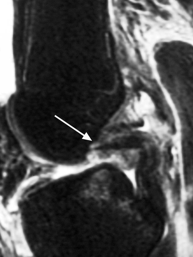 Imaging of the Reverse Segond Fracture Fig. 2. 36-year-old woman involved in pedestrian-versus-automobile collision.