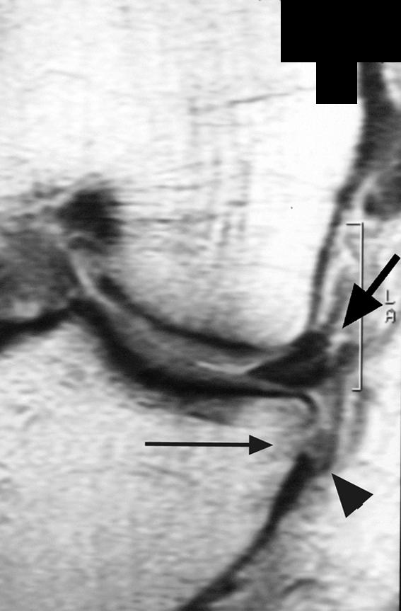 , Proton density weighted fast spin-echo coronal MR image of knee shows bony avulsion (arrowhead) of deep medial collateral ligament with cortical defect (small arrow).