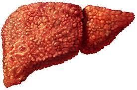 Fatty liver disease changes the sensitivity to toxin exposure that enhances liver