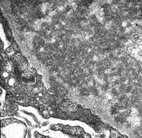 9.6 Systemic Diseases and the Kidney FIGURE 9-12 Electron microscopy of subendothelial and endocapillary deposits showing an amorphous structure.