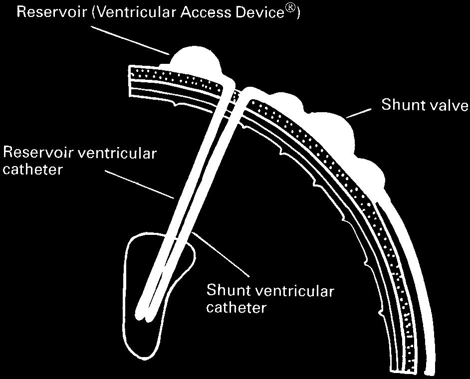 absence of flow, the reservoir ventricular catheter will not attract debris or choroid plexus and is unlikely to get obstructed.