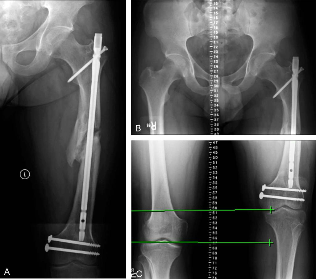Liporace and Yoon FIGURE 1. A C, A 36-year-old man presenting to our office with radiographs exhibiting femoral nonunion with a limb length discrepancy of approximately 6.5 cm.