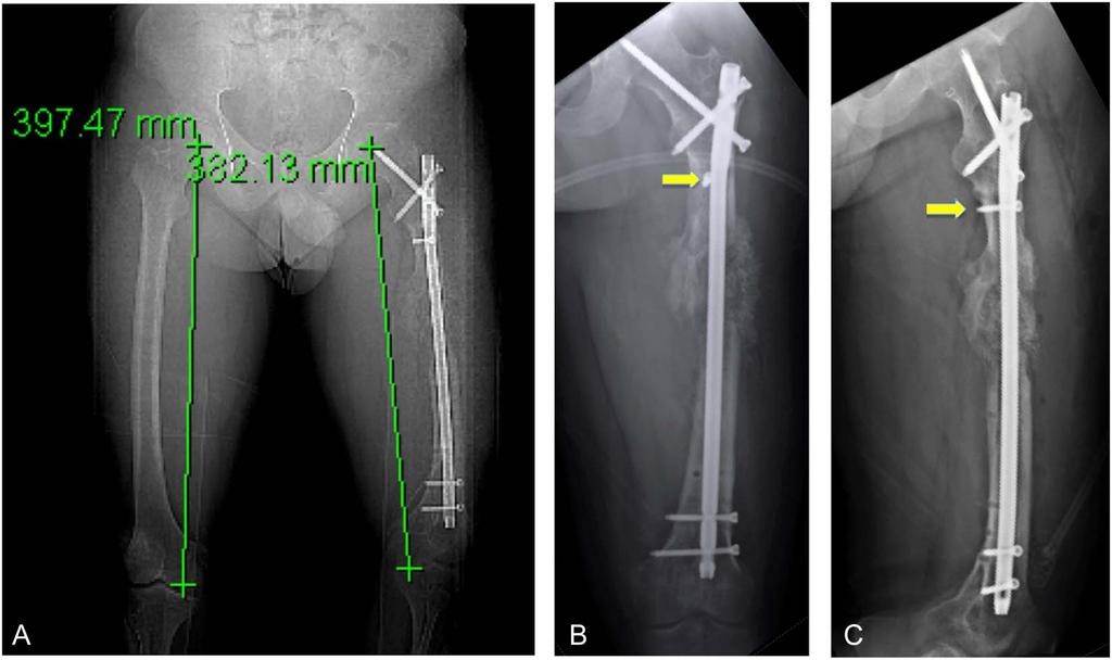 IMN for Subtrochanteric Nonunion FIGURE 3. A C, After 7 months of lengthening, scant regenerate was seen on radiographs.