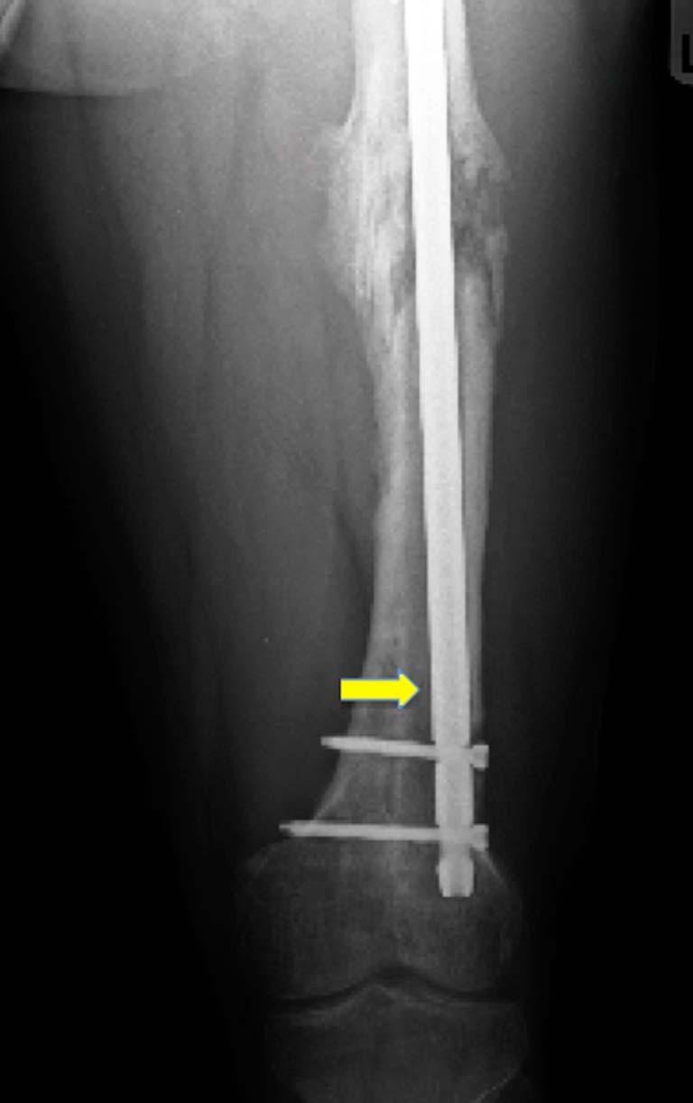 Because of the scant regenerate, repeat exchange IMN was performed with autograft and placement of a medial Poller screw (arrow) to aid in achieving acceptable alignment, despite the capacious