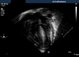 Echocardiogram: M-mode LV Septum Post Wall LV Normal IDM with HCM Hypertrophic Cardiomyopathy Cause of circulatory failure diastolic dysfunction low