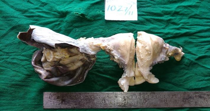14 12 10 8 6 4 2 0 AGE Figure 6: Hysterectomy specimen along with left ovarian dermoid cyst showing
