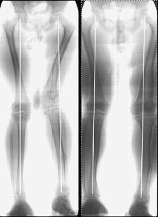 222 J. HORN, L. P. KRISTIANSEN, H. STEEN Fig. 2. Patient with partial physeal arrest at the proximal tibial physis after osteomyelitis (left).