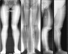 epiphysiodesis and corrective lengthening osteotomy in patients with deformities due to partial physeal arrest and a significant amount of remaining growth.