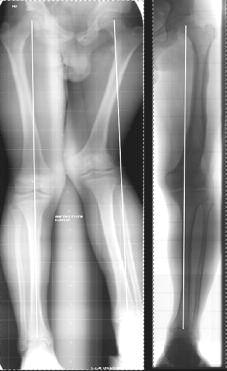 DEFORMITY CORRECTION DURING GROWTH 223 Fig. 4. Patient with lateral partial physeal arrest after distal femoral fracture. Left : Preoperatively. Right : After the correction, at skeletal maturity.