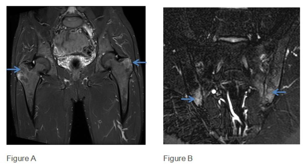 Fig. 4: Figure A :MRI STIR Coronal pelvis: Marrow oedema and cortical irregularity at the greater trochanters (blue arrows) in keeping with acute enthesitis in a case of Crohn's.