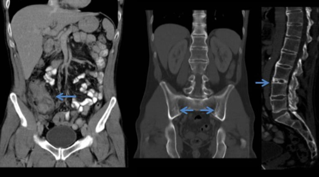 Fig. 7: Coronal and sagittal CT images demonstrating ankylosed SI