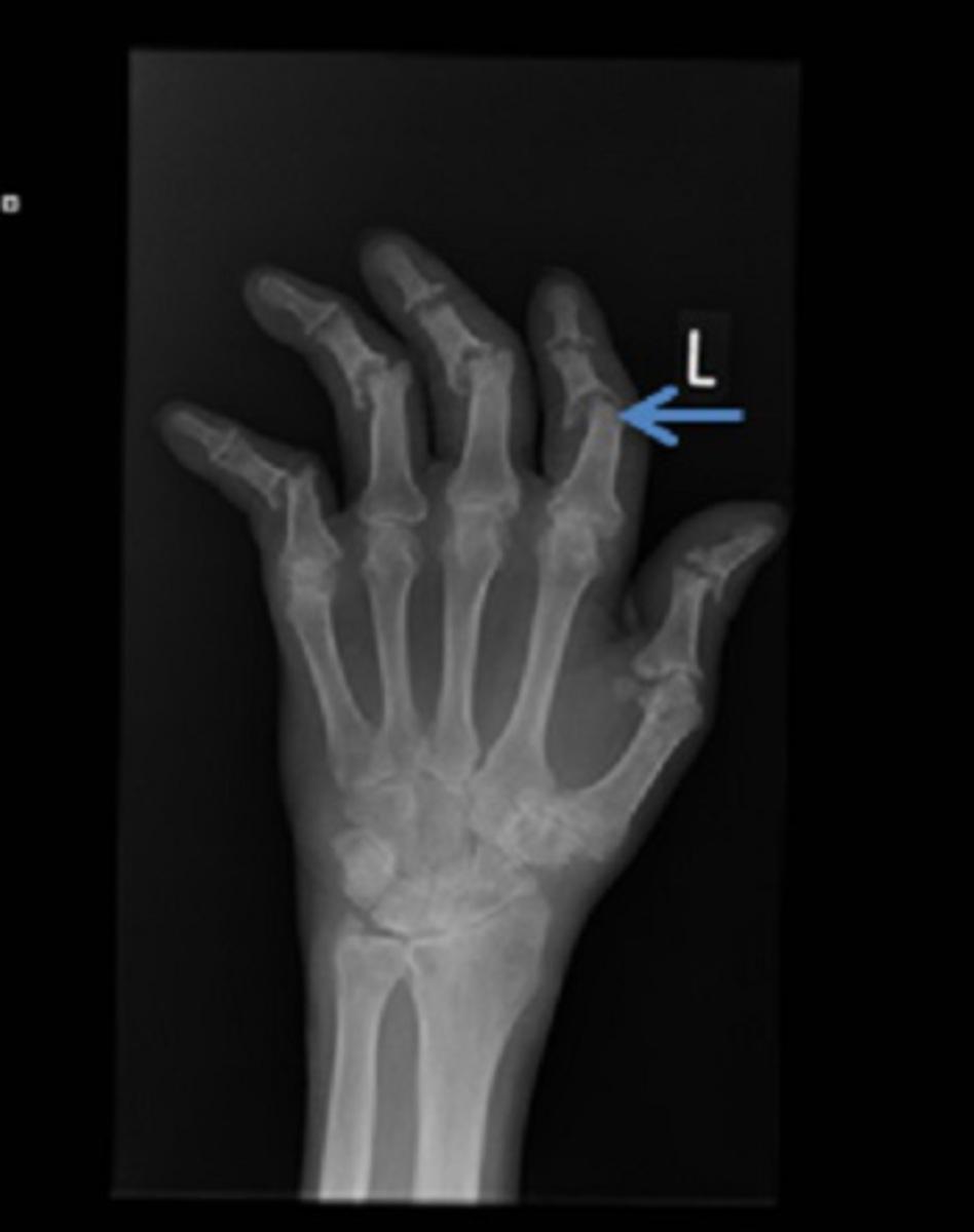 Fig. 1: Radiograph of left foot showing extensive fluffy new bone formation along the