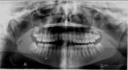 DENTAL ANOMALIES fractured incisor Pre- retention