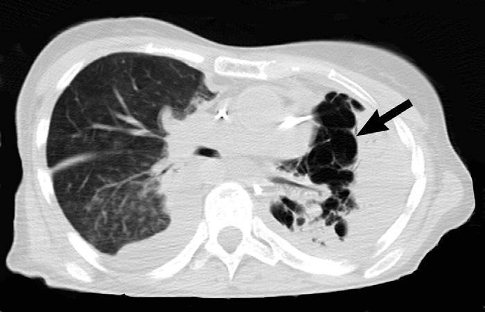 embolized previously consolidated medial left lung (arrow). Pleural thickening was increased bilaterally. Groundglass opacity of the right lung likely represented aspirated blood. Figure 4.