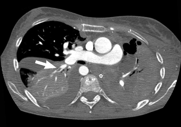 Pulmonary arterial flow was nearly entirely to the right lung despite injection of contrast medium in the left main pulmonary artery.