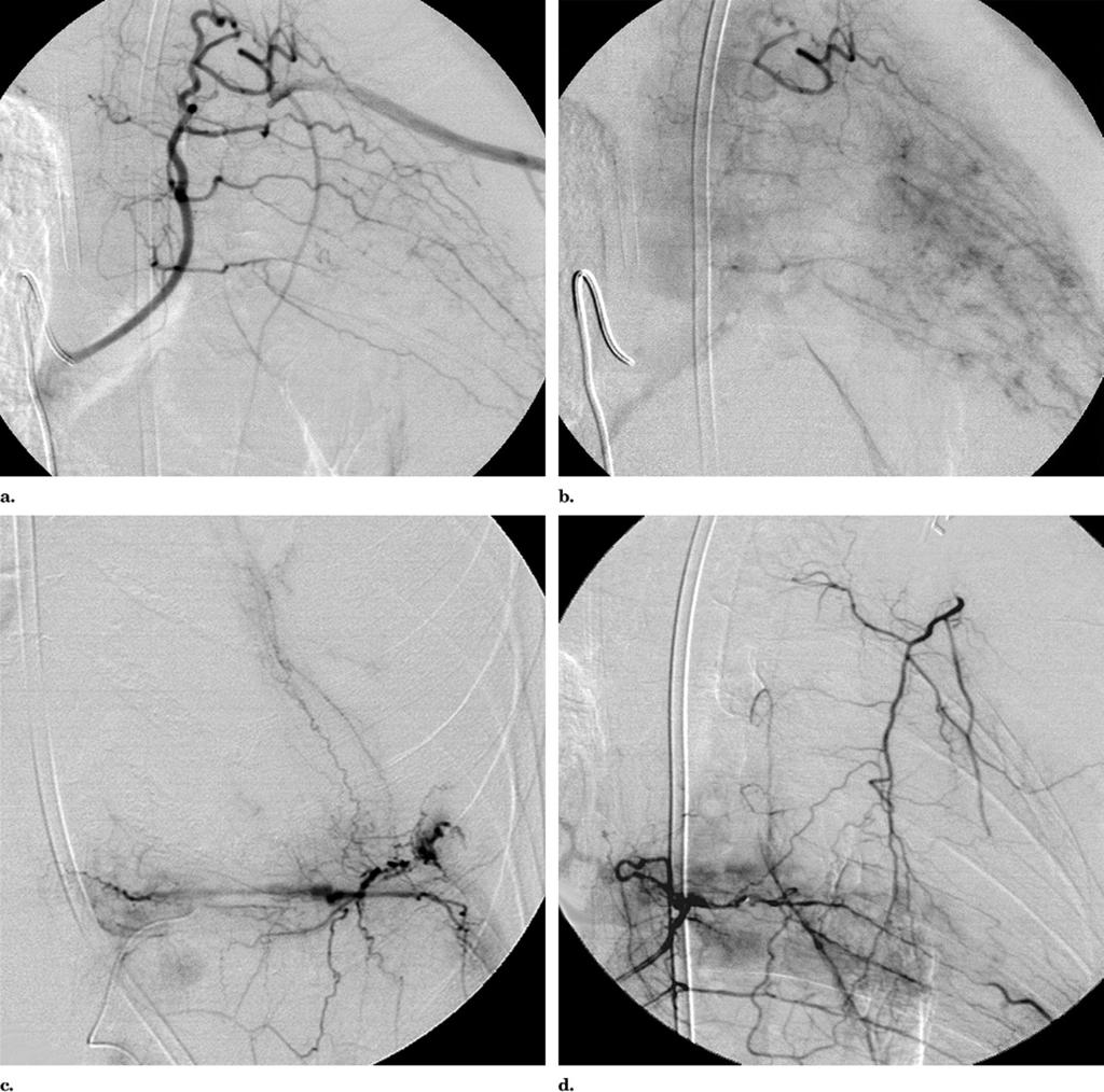1136 SIR 2008 Film Panel: Radiation-induced Angiosarcoma August 2008 JVIR Figure 8. A second bronchial embolization procedure was performed.