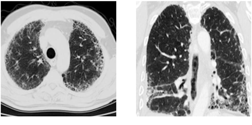910 Imaging Findings of Interstitial Lung Disease (A) Fig.