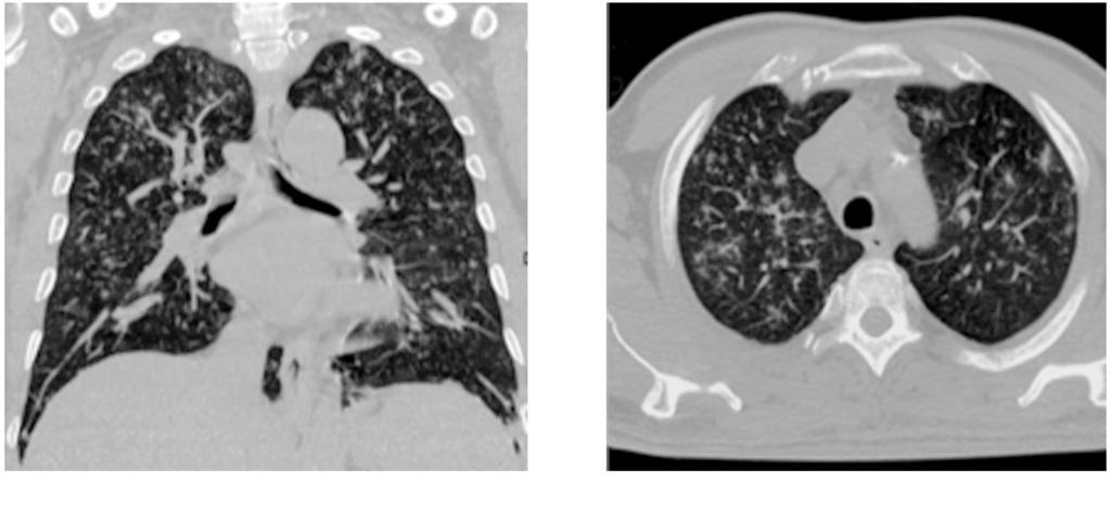 Ahmed A. Ismail & Eman Shabl 911 (A) Fig. (4): A 51-year-old female patient complains of chronic cough and dyspnea.