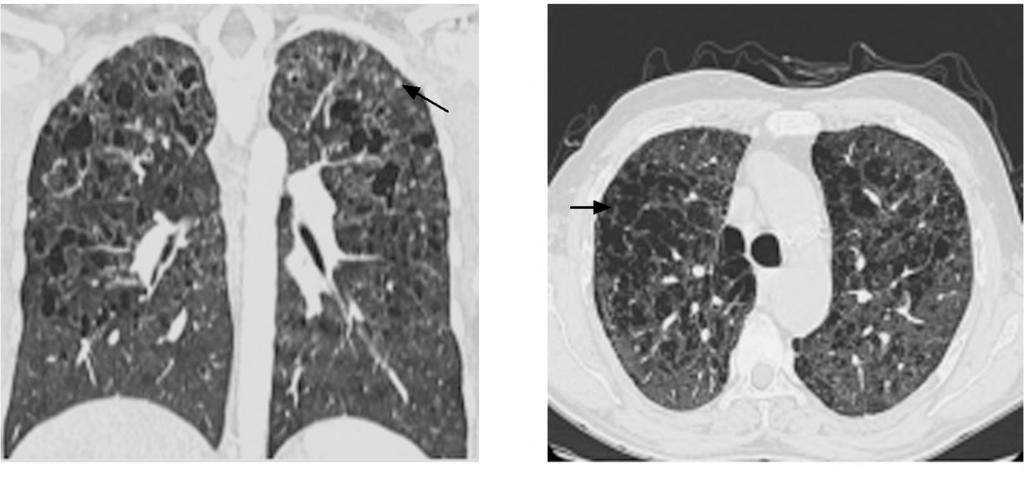 Some nodules are miliary-like. (B) (A) Fig. (5): A 29-year-old male patient complains of dry prolonged cough with cystic lung changes in LCH.