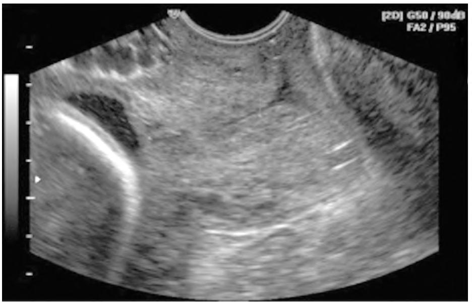 918 Preinduction Ultrasonographic Measurements as a Predictor The occurrence of occipito-anterior position was significantly higher in Group A in comparison to the failed induction group.