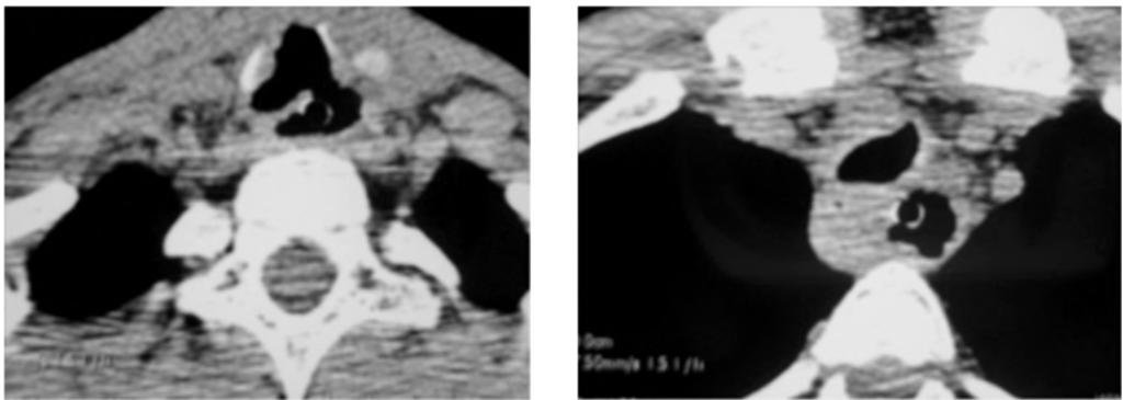 Case (3): Axial CT chest images (mediastinal and lung windows) in a 83 year-old female patient showing right
