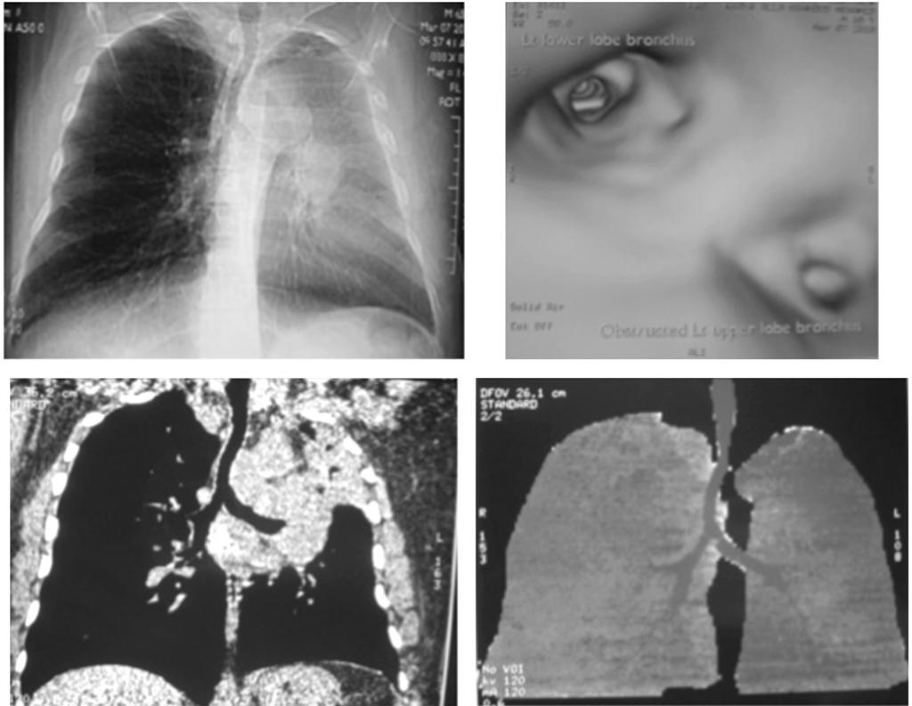 Axial CT chest images (lung window) showing marked surgical emphysema with residual anterior mid-line tract along the path of the original penetrating object.