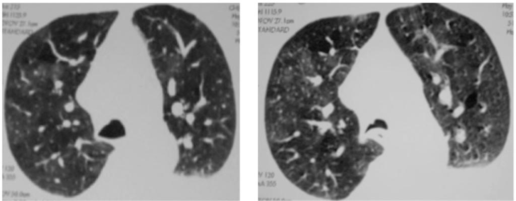 Virtual bronchosco- py (scout, VB, axial mediastinal window, MinIP coronal images) and axial mediastinal window images) in case of right central Bronchogenic carcinoma, showing marked