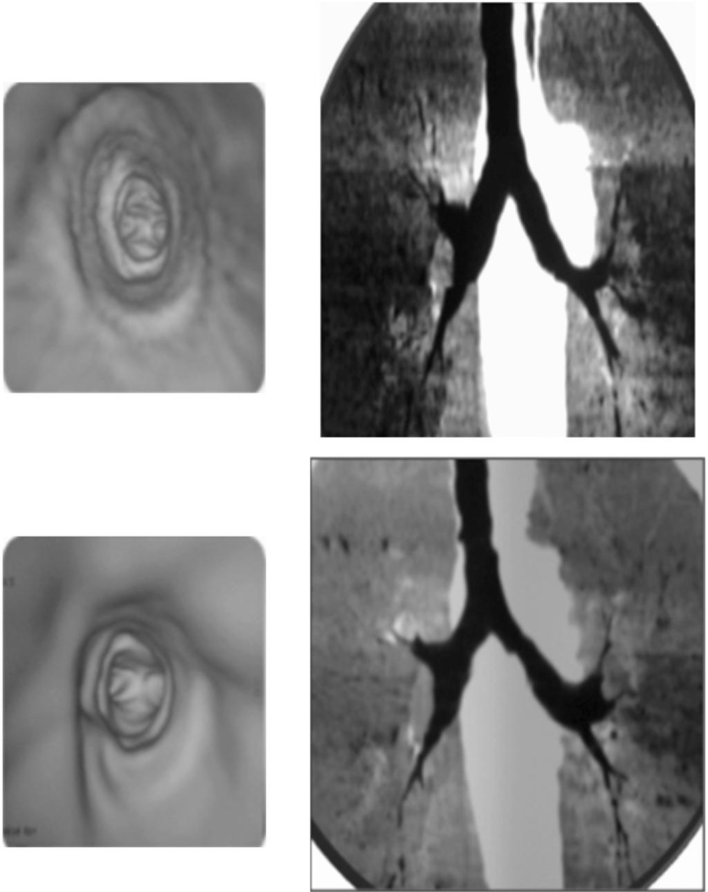 Youssriah Y. Sabri, et al. 955 Inspiratory Expiratory Case (10): Male patient 10 years old with suspected tracheomalacia referred for follow virtual bronchoscopy.