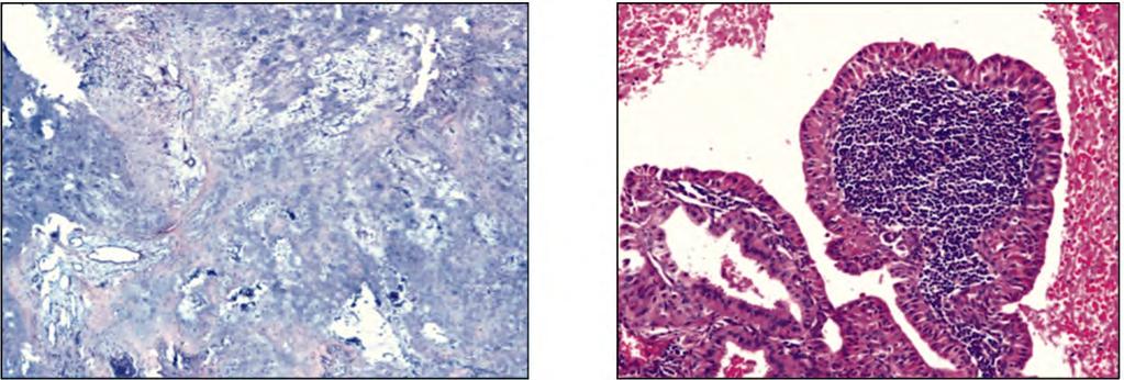 970 Salivary Gland Neoplasms a Histopathological & Statistical Study Fig.