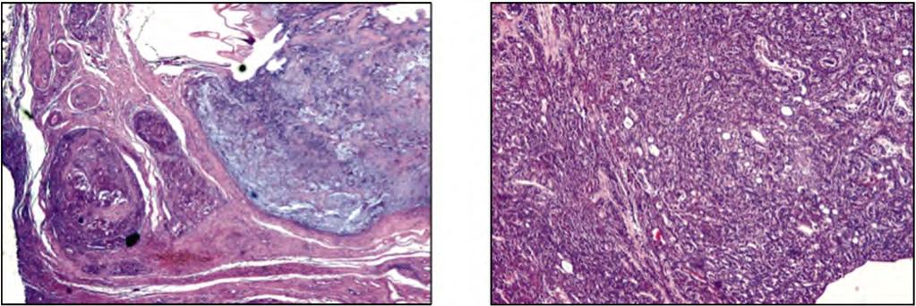 Gina A. Nakhla, et al. 971 Fig. (7): Adenocarcinoma (Left) on top of pleomorphic adenoma (Right) (H & E x100). Fig. (8): Basal cell adenoma showing basaloid cells in a solid and glandular pattern (H & E x100).