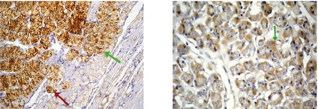 Fig. (5): Papillary thyroid carcinoma/follicular variant showing diffuse positive Cytoplasmic staining with membranous accentuation