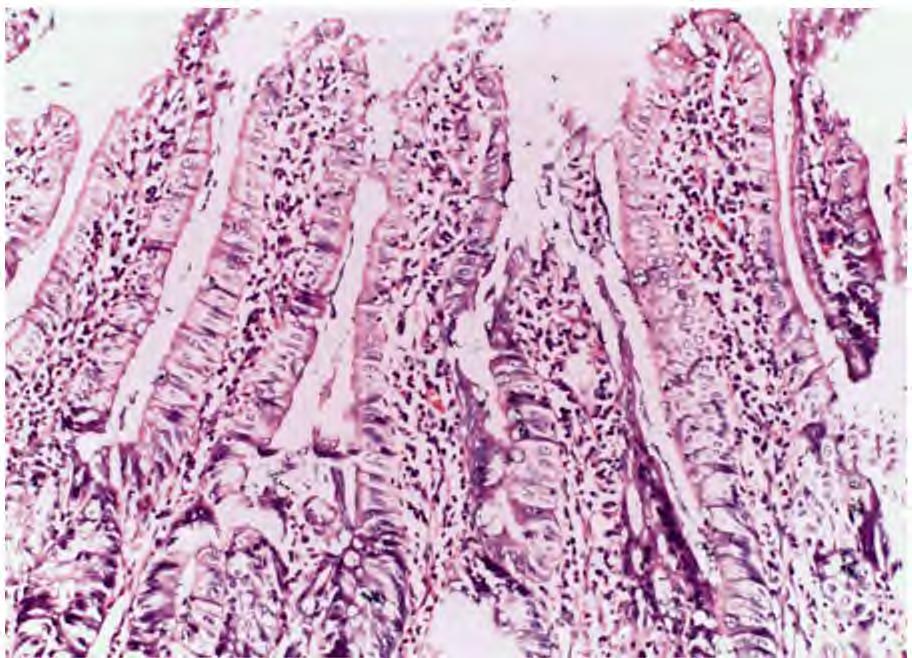 (7): Photomicrograph of section of jejunum of MTXtreated rats showing apoptotic cells (arrows) and inflammatory infiltrate in lamina propria (H & E x400).