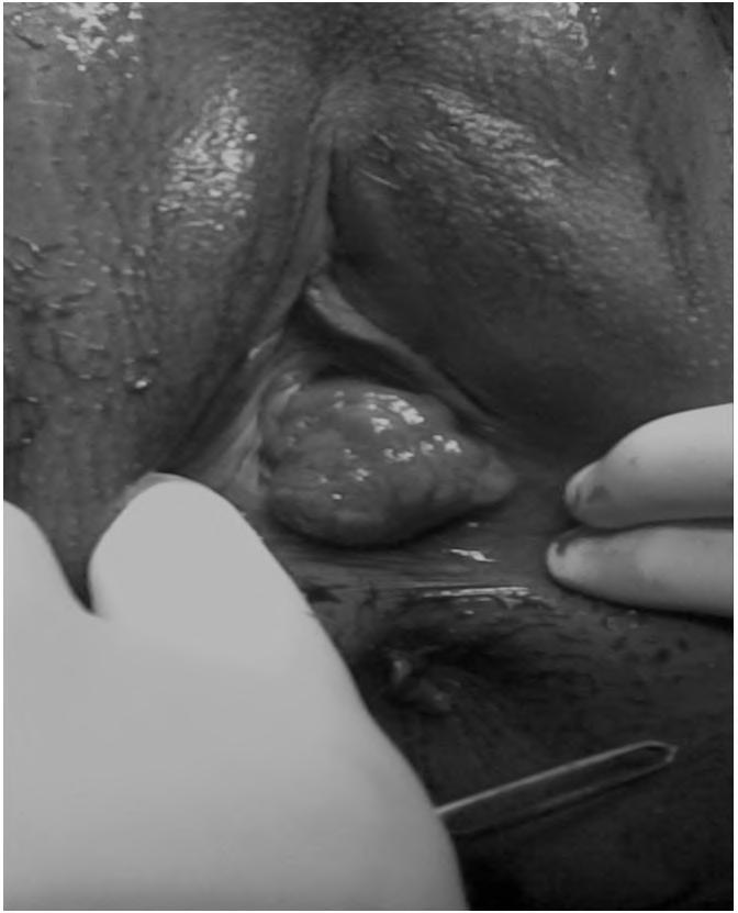 1134 Case Report: Vaginal Neurofibroma neurofibroma differ as a mass or pain or acute urine retention up to obstructed labour.