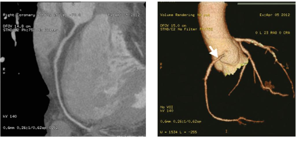 842 Cardaic CT Coronary Angiography Screening of Coronary Artery (A) Fig.