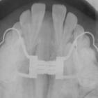 patients present with clinical indications for maxillary expansion