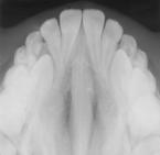 through enhancement of sutural growth at the midpalatal suture