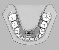 Long-Term Stability of Rapid Maxillary Expansion Concurrent with Schwarz Appliance Therapy in the Mixed Dentition Schwarz app.