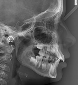 orthopedic procedure to manage a variety of clinical conditions associated with maxillary