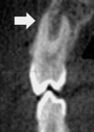 TREATMENT PROTOCOL Angle Orthod 213;83:172-182 The vertical changes found after RME