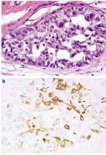 DCIS with a Basal-Like Phenotype Bryan, Mod Pathol, 2006 Is there an identifiable precursor lesion to invasive basal-like breast cancer?