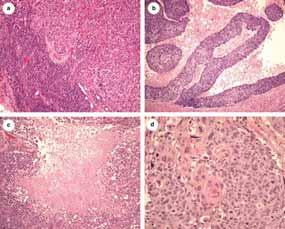 Histology of Basal-Like Cancers Identified By Expression Profiling