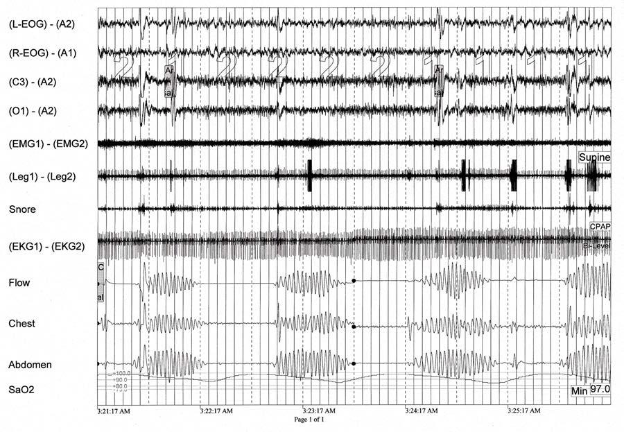 Polysomnogram Features (Figure 7 & 8) The two common conditions producing central sleep apnea have a slightly different event appearance on polysomnography.
