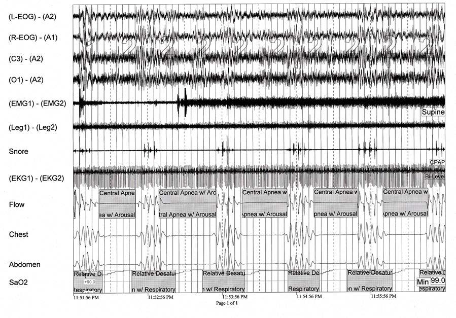 FIGURE 8 CENTRAL APNEA SECONDARY TO NARCOTIC MEDICATIONS Figure 8: A five-minute recording of stage II sleep showing typical central apneas.