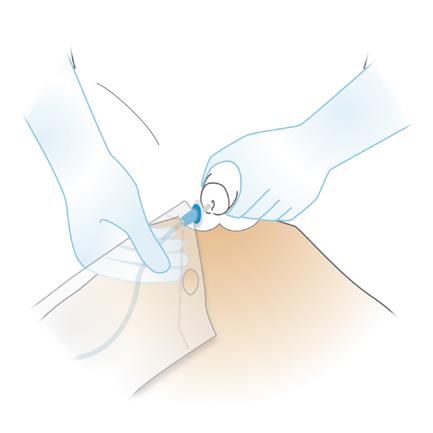 Sterile Self-Intermittent Catheterization Instructions for Men continued 5. Put on the gloves provided in the kit. Open the povidone-iodine swabsticks or BZK wipe provided in the catheter kit. 6.