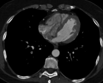 CASE 2 Woman, 57 y/o with ACP and lightheadness in the ER, normal