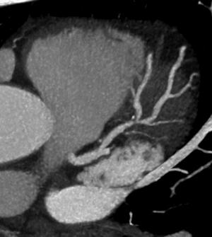 Coronary CTA Stenosis Detection Radiation dose reduction techniques 1. Decrease scan range 2.