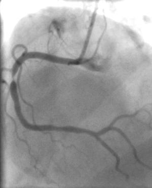 specificity Multi-Center Trials: Stenosis Detection by CT Angiography n